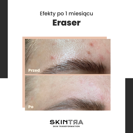 SkinTra - Eraser - Serum na Przebarwienia z Witaminą C 10% - 30ml OUTLET