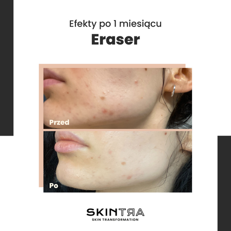 SkinTra - Eraser - Serum na Przebarwienia z Witaminą C 10% - 30ml OUTLET